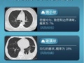 调查｜原装进口保健品声称“可治疗肺结节，改善肺癌”：国内代工厂提供一条龙进口服务，一瓶成本可低至10元