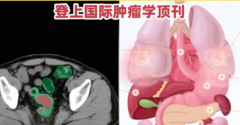 误诊率仅有0.2%! 阿里达摩院AI全球首次实现肠癌无感检测，登上国际肿瘤学顶刊