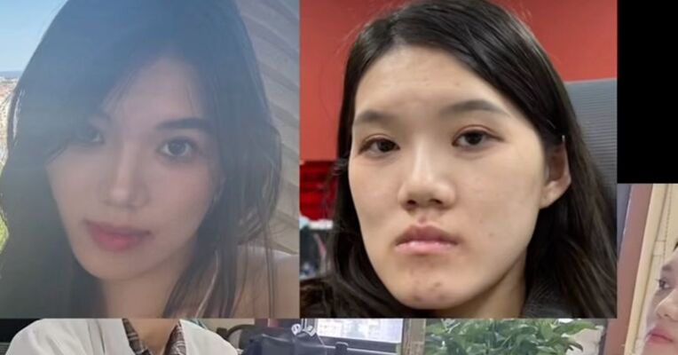 女孩做正颌手术成“鞋拔子脸”，武汉大学口腔医院通报，术后牙根被钉子打穿，鼻子不通气，主刀医生：“现在比之前更洋气”