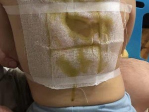 江西省儿童医院：三伏贴致92名儿童现不良反应，已暂停