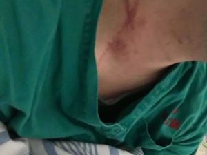 武汉2名医生被患者家属打伤，防护服被撕扯致重度职业暴露
