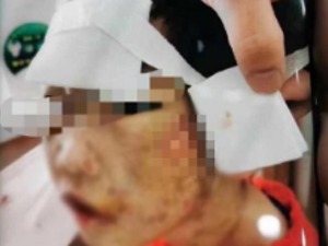 女童屡遭拳殴开水烫拽发撞墙，致重伤二级 警方最新通报：其生父及同居女友被刑拘