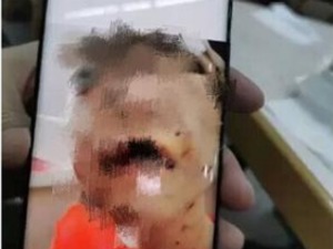 女童屡遭拳殴开水烫拽发撞墙 医院：有生命危险，全院会诊中