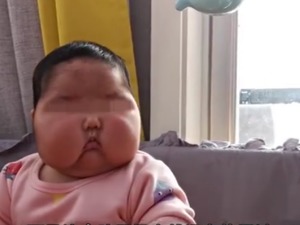 “大头娃娃”能否康复？专家：面部或消肿，但假如错过最佳发育期，错过了就是错过了